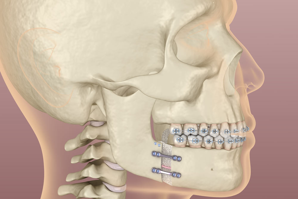 Dr Chris Orthognathic-surgery 2