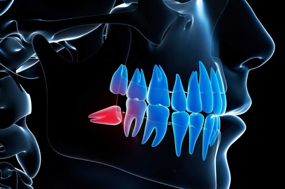 Wisdom Teeth Removal 2